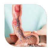 How to Treat Ulcers أيقونة