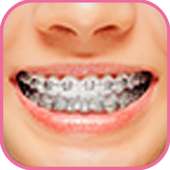 Braces Bretelles teeth both 2018