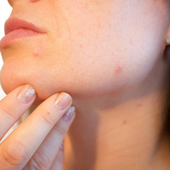 Treating Acne during Pregnancy icon