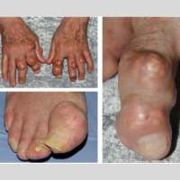 Gout/ Uric Acid Latest Version on 9Apps