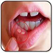 Remove a Mouth Ulcer on 9Apps