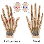 Remedios Naturales Artritis