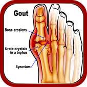 Home Remedies for Gout