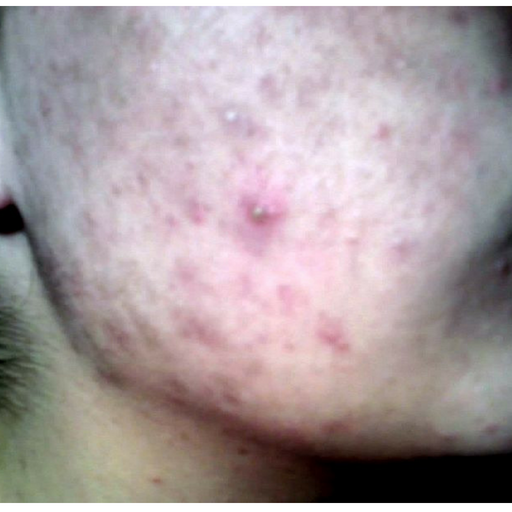 How To Get Rid of Pimples/Acne icon