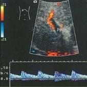 Role Of Doppler in Portal hypertension on 9Apps