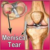 Meniscal Tear on 9Apps