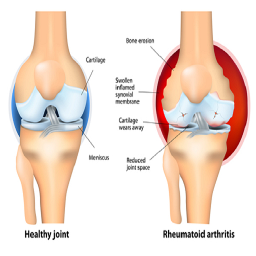 Arthritis Treatment Free App - Cure Arthritis icon