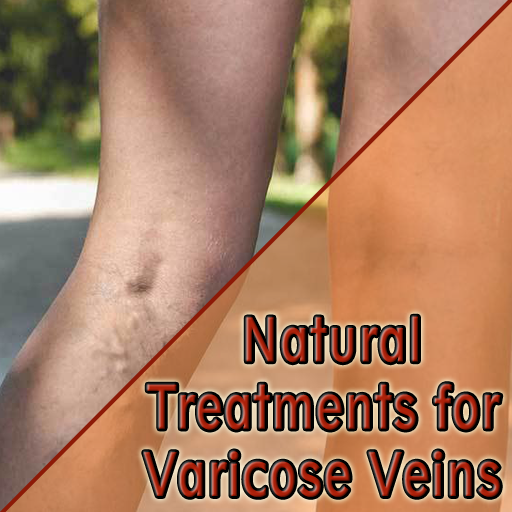 Natural Treatments for Varicose Veins иконка