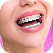 Top Design Braces teeth