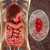 Ulcer Natural &amp; Home Remedies icon