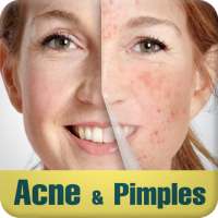 Acne & Pimples on 9Apps