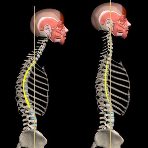Kyphosis &amp; Rounded Back by M&amp;M icon