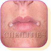 How to treat Angular Cheilitis at Home Naturally on 9Apps