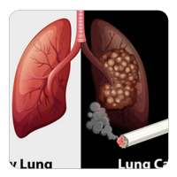 Lung cancer guide