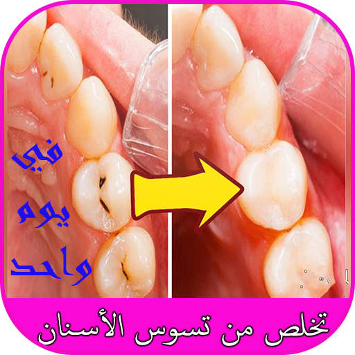 تخلص من تسوس الأسنان في يوم واحد أيقونة