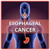 Esophageal Cancer