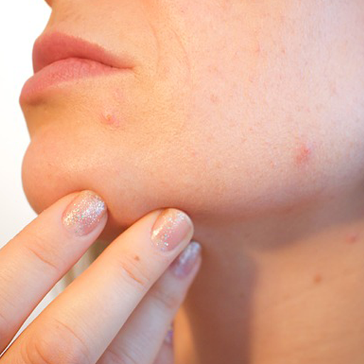 علاج حب الشباب للبشرة الدهنية طبيعيا आइकन