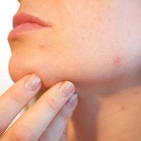 علاج حب الشباب للبشرة الدهنية طبيعيا on 9Apps