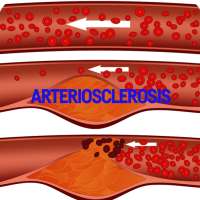 Arteriosclerosis Disease on 9Apps