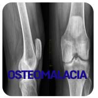 Osteomalacia Disease on 9Apps