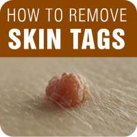 Skin Tag Removal - How to Remove Skin Tags on 9Apps