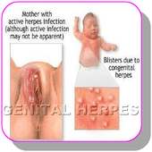 Home remedies for Genital herpes infection on 9Apps