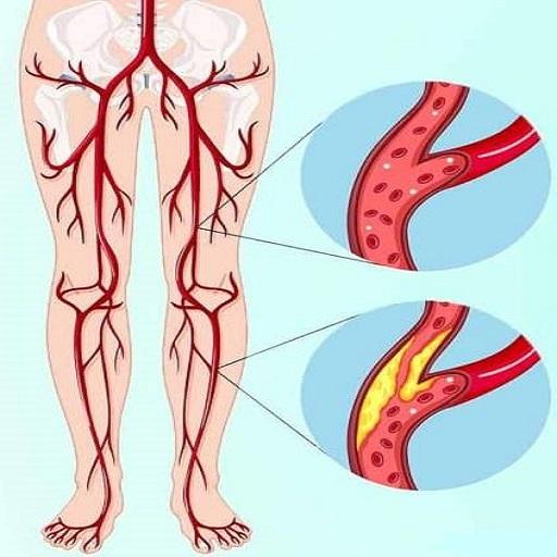 Peripheral Vascular Diseases and their Management icon