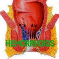 Hemorrhoids Disease on 9Apps