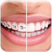 Braces On Photo on 9Apps