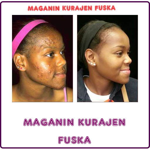 Maganin Kurajen Fuska icon
