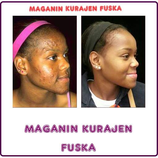 Maganin Kurajen Fuska