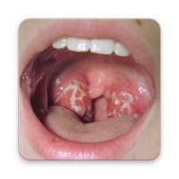 Tonsils Home Remedy on 9Apps