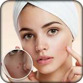 Pimple Remover : Beauty Plus on 9Apps