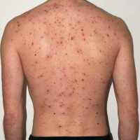 Home Remedy for Chicken Pox