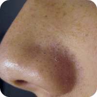 Remove Blackheads Home Remedy