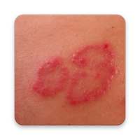 How to Cure Skin Rashes on 9Apps