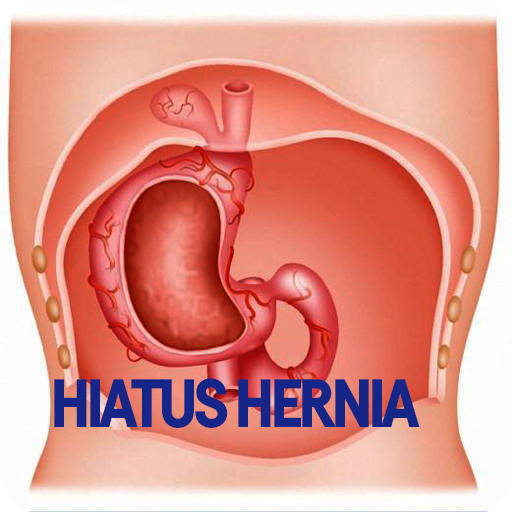 Hiatus Hernia Disease أيقونة