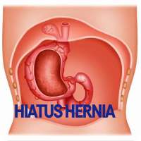 Hiatus Hernia Disease on 9Apps