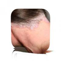 Scalp Psoriasis Guide on 9Apps