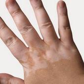 علاج البهاق أيقونة