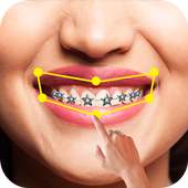 Braces Pro on 9Apps