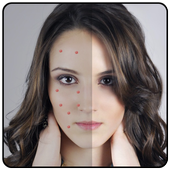 Acne Remover Zit remover Pimple Eraser icon