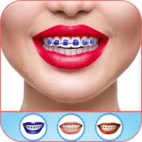 Braces Photo Editor 2023