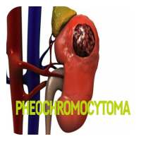 Pheochromocytoma on 9Apps