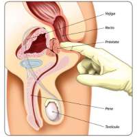 Preguntas Sobre La Próstata