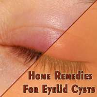 Home Remedies For Eyelid Cysts (Chalazion) on 9Apps