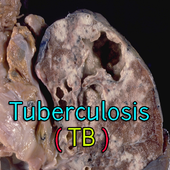 Tuberculosis TB icon