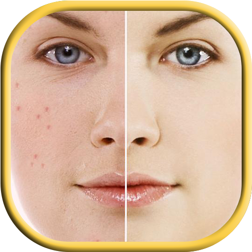 خلطات مجربة لإزالة حب الشباب أيقونة