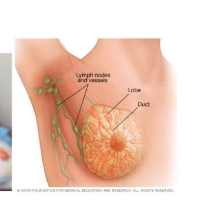 Amharic guide on breast cancer on 9Apps