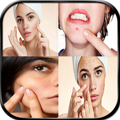 أفضل الوصفات لإزالة حب الشباب أيقونة